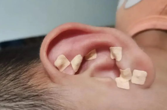 义诊福利|小巧耳穴贴,轻松伴日常