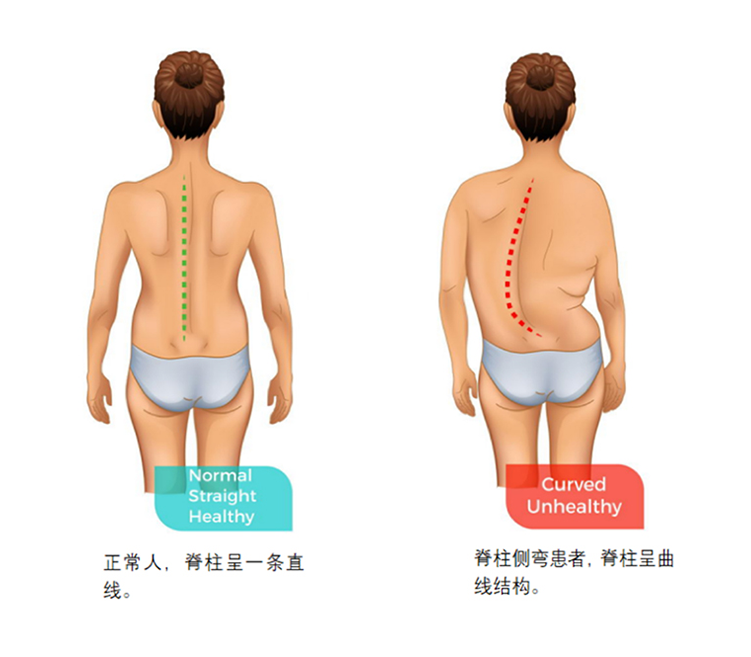 不容忽视的脊柱健康警报——认识脊柱侧弯
