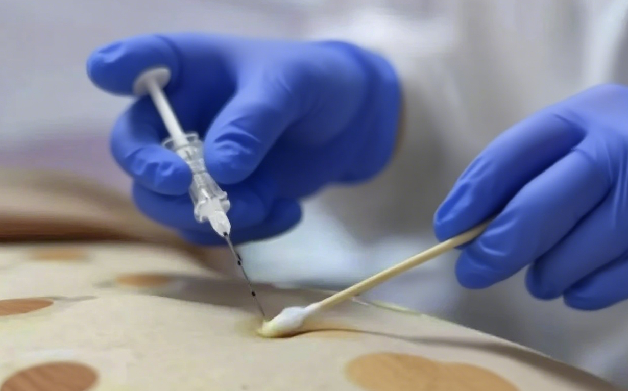 身材告急？中式埋线帮你轻松享“瘦”不费力！