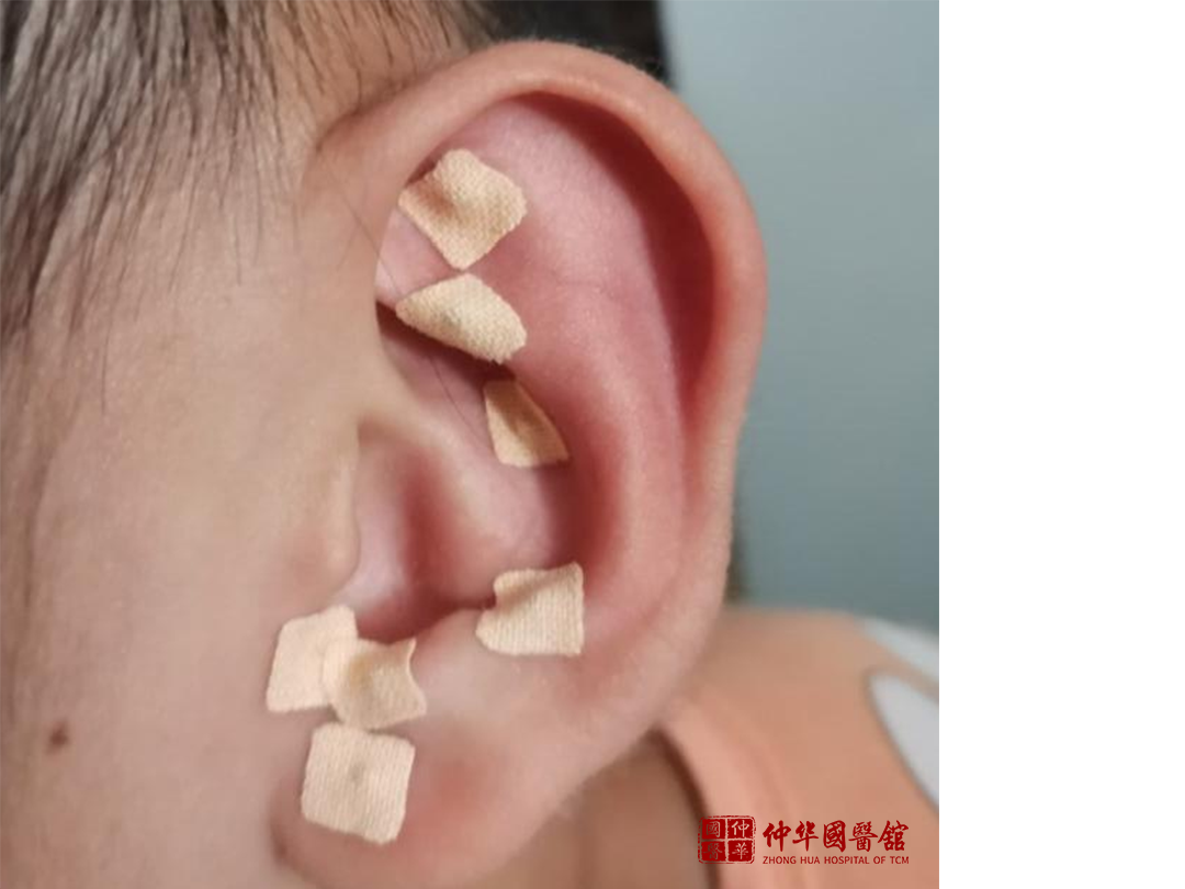 年轻人的新时尚——耳穴