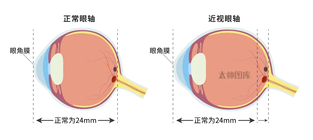 孩子视力差别只盯屏幕！肝脾肾失调才是根源，5 个中医护眼方收好